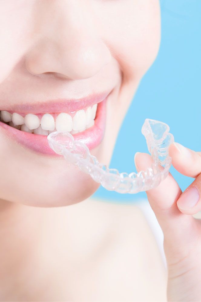 Mosolygó nő átlátszó Invisalign sínnel a kezében